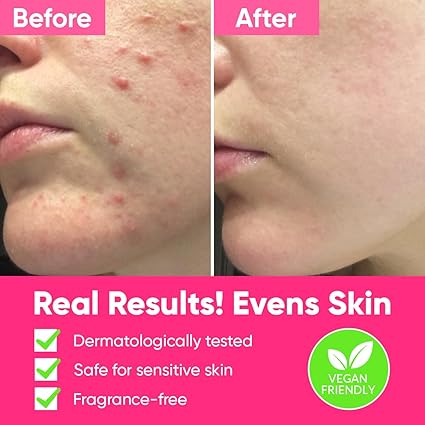 Ame Pure Peel So Good Chemical Peel – 120 ml Gentle Exfoliating Peeling Gel – Chemical Peel For Face - Reveals Radiant Skin - Chemical Exfoliant For Skin Rejuvenation- Transform Your Skin Today!